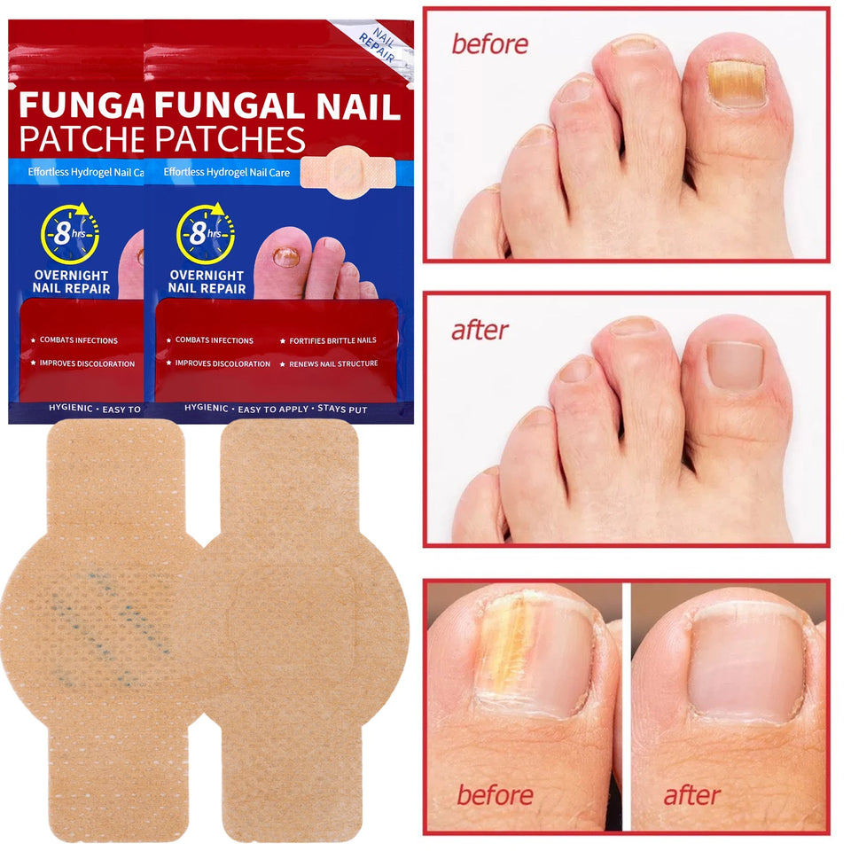 21pcs Waterproof Nail Fungus Patch Toenail Repair Sticker Anti Infection Ingrown Toenail Correction Foot Care
