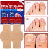 21pcs Waterproof Nail Fungus Patch Toenail Repair Sticker Anti Infection Ingrown Toenail Correction Foot Care